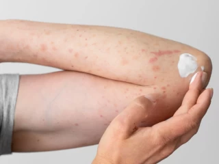Best Antifungal Cream PCD Pharma Company India