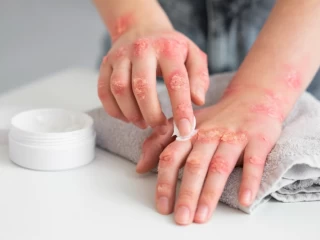 Top Antifungal Cream PCD Pharma Companies in India
